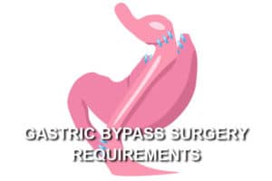 gastric bypass surgery requirements